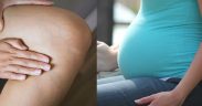 Tips Ampuh Mengatasi Varises saat Kehamilan Trimester Kedua