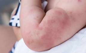 Mengetahui gejala alergi bayi