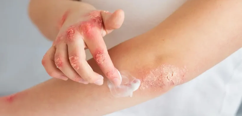 Dermatitis Atopik : Gejala, Penyebab, dan Cara Mengobati